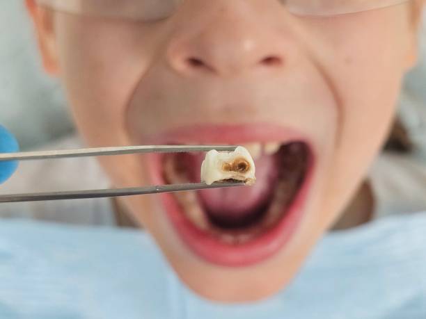 Best Emergency Dental Extractions in Milliken, CO